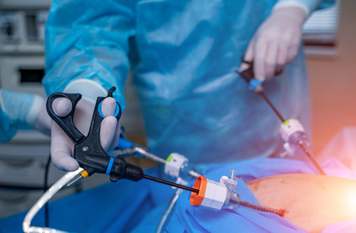 Cirugía Laparoscópica de Hernia Inguinal: Solución Minimmente Invasiva para Hernias